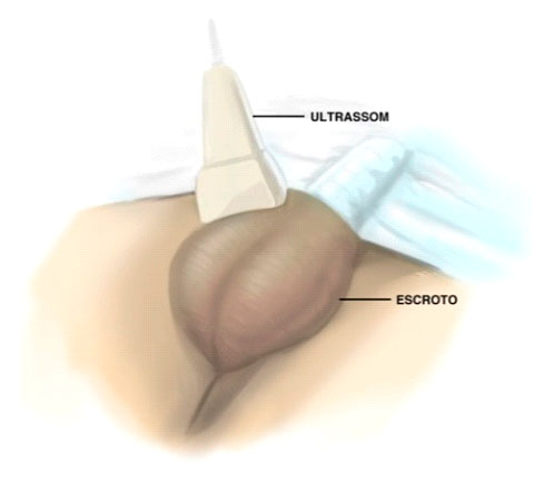 Ultrassom de bolsa escrotal