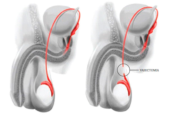 Reparo da vasectomia